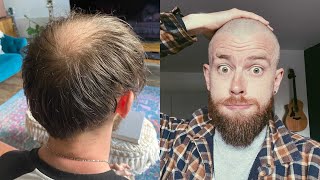 BUZZ CUT vs HIDING MY BALDINGTHINNING CROWN TRANSFORMATION [upl. by Halsy]