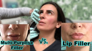 Lip Fillers 450 Compared to 700  RestylaneJuvederm Versus Restylane Kysse [upl. by Yer869]