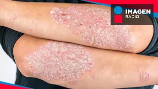 ¿Qué es y qué causa la Psoriasis [upl. by Saihttam]