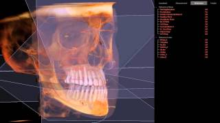 3D Cephalometric Analysis [upl. by Akila562]