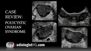 Ultrasound of Polycystic Ovarian Syndrome [upl. by Dewey]