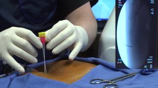 Ganglion Impar Block  Offered in Las Vegas Nevada [upl. by Libyc]