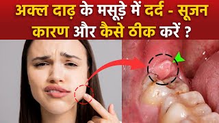 Pericoronitis Treatment At Home Akal Daad Ke Masude Fulne Ka Ilaj Wisdom Teeth Gum Swelling Remedy [upl. by Gnol]