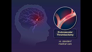 Stroke Endovascular management of ischaemic stroke  radiology video tutorial [upl. by Llednov]