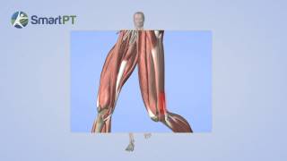 Tensor Fascia Latae Syndrome [upl. by Dela]