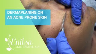 Dermaplaning On An Acne Prone Skin [upl. by Tompkins612]