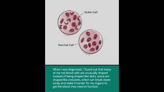 Sickle Cell Disease Hemoglobin S Disease [upl. by Ehc277]