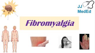 Fibromyalgia  Symptoms Associated Conditions Diagnosis Treatment [upl. by Croft]