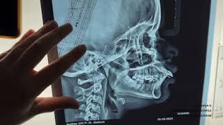 Demostration on Jarabaks Cephalometric Analysis  DrRasiga Gandhi  Department of Orthodontics [upl. by Trebo]