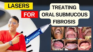 Dr Rudra Mohan  Oral Submucous FIbrosis Treatment with Laser Therapy  OSMF Treatment Diode Laser [upl. by Jablon]