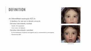 Intermittent Exotropia Characteristics [upl. by Ijic916]