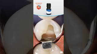 Ultradent Products Restorative Solution  Case 2 [upl. by Irita]