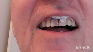 How to fix a chipped front tooth [upl. by Anidnamra693]