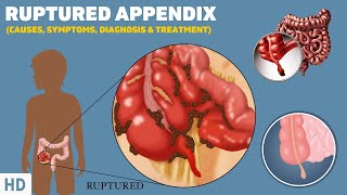 What is Appendicitis A real case of Burst Appendix [upl. by Eixid]