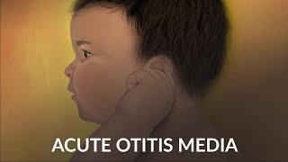 Acute Otitis Media by A Ruan J Cheng  OPENPediatrics [upl. by Euqinahs]