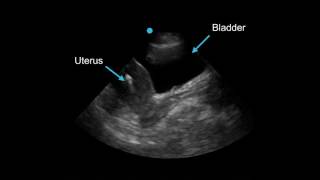 Performing a kidney or renal study in Point of Care Ultrasound POCUS [upl. by Anyahs]