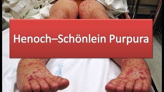 HenochSchönlein Purpura [upl. by Aetnahc883]