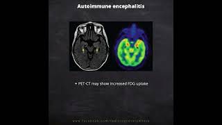 Autoimmune Encephalitis Radiological imaging [upl. by Akamaozu812]