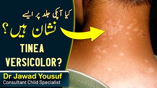 Tinea versicolor skin infection children  treatment  Causes  In Hindi Urdu Healers Online [upl. by Ribak74]