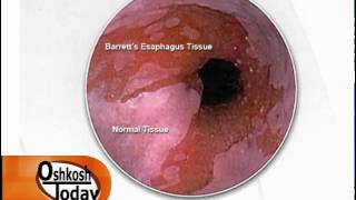 Barretts Esophagus [upl. by Xenia]