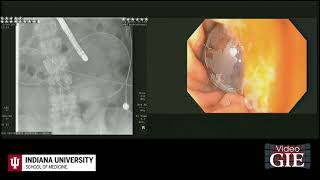 Endoscopic management of acute buried bumper syndrome [upl. by Yrret]