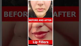 Lip Filler Amazing Result At Shobhit Aesthetics [upl. by Yniatirb]