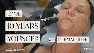 Look 10 Years Younger With Dermal Filler  Before amp After  Total Transformations Ep 5 [upl. by Shanks]