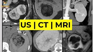 Imaging of Renal Masses ALL YOU NEED TO KNOW  Dr Daniel J Kowal RadiologistHQ [upl. by Retsbew14]