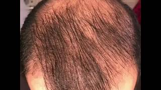 8 months using minoxidil  Rogaine 5 Before amp After results [upl. by Erle]