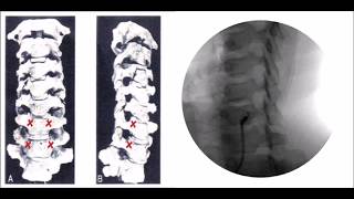 How to perform Stellate Ganglion Block Treatment [upl. by Odnomor]