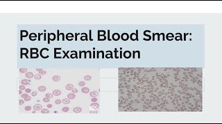 Peripheral Blood Smear Examination of RBC [upl. by Roi574]