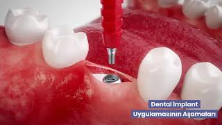 Dental İmplantın Aşamaları Nelerdir [upl. by Nirrej520]