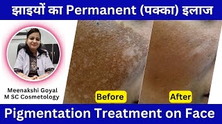 Pigmentation Treatment on Face  Hyperpigmentation Treatment [upl. by Aloysia]