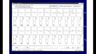 How to interpret Holter ECG [upl. by Ihcas]