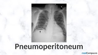 Pneumoperitoneum Chest XRay Signs  High Yield  Radiology [upl. by Byran155]