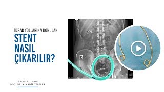 İDRAR YOLLARINA KONULAN STENTİN ÇIKARILMASI [upl. by Afatsum]