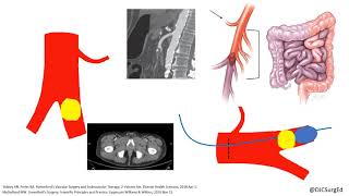 Acute Limb Ischemia [upl. by Ydissac481]