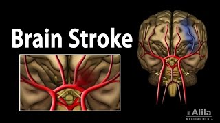 Brain Stroke Types of Causes Pathology Symptoms Treatment and Prevention Animation [upl. by Jamilla748]