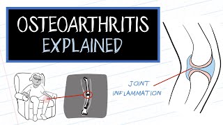 What is Osteoarthritis HealthSketch [upl. by Osyth]