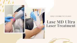 LaseMD Ultra Laser Treatment on Hands amp Forearms  Live with Dr Nadir Qazi [upl. by Eiraminot198]