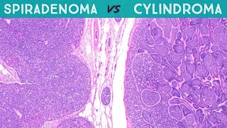 Spiradenoma vs Cylindroma Dermpath in 5 Minutes pathology dermatology dermatopathology sweat gland [upl. by Anir]