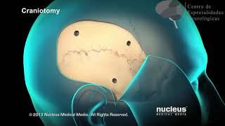¿Qué es una Craneotomía [upl. by Amiaj]