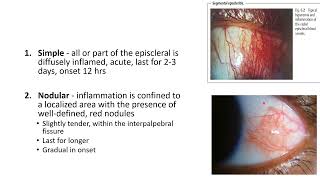 EPISCLERITIS AND SCLERITIS [upl. by Linnell]