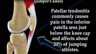 Patellar Tendonitis Jumpers Knee  Everything You Need To Know  Dr Nabil Ebraheim [upl. by Richara]