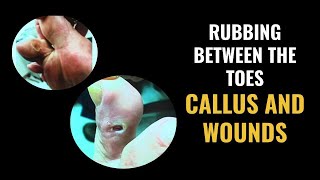 Rubbing Between The Toes  Calluses and Wounds [upl. by Denna]