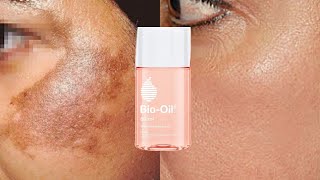 How To Use Bio Oil To Treat Pigmentation Dark Spots amp Acne Scars  Skin Lightening Home Remedies [upl. by Assilac638]