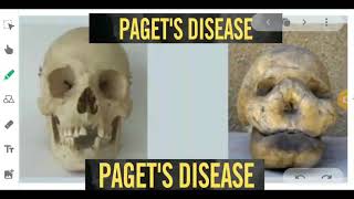 PAGETS DISEASE OF BONE  ORAL PATHOLOGY  RADIOLOGY [upl. by Latoye]