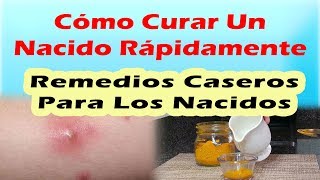 REMEDIOS CASEROS PARA LOS NACIDOS Como Curar Un Nacido Rápidamente [upl. by Lairbag]