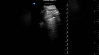 Right Pleural Effusion with Compression Atelectasis [upl. by Philcox626]