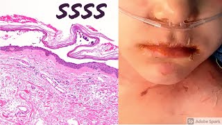 Staphylococcal scalded skin syndrome SSSS 5Minute Pathology Pearls [upl. by Suoiluj16]